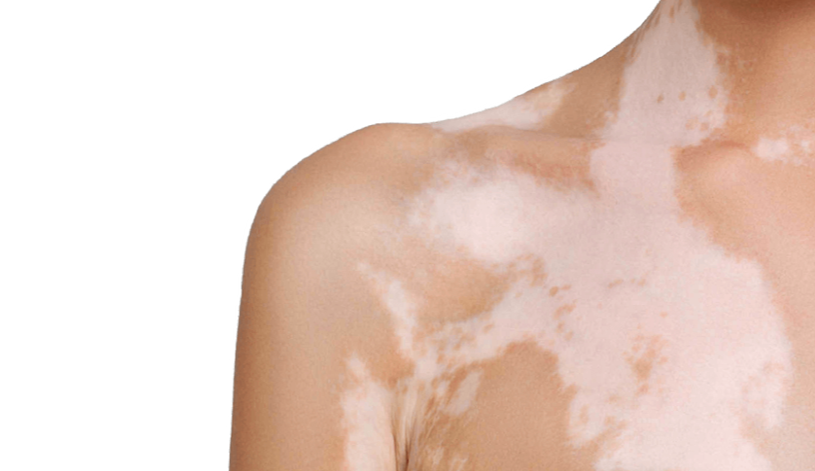 ¿El vitíligo es contagioso?