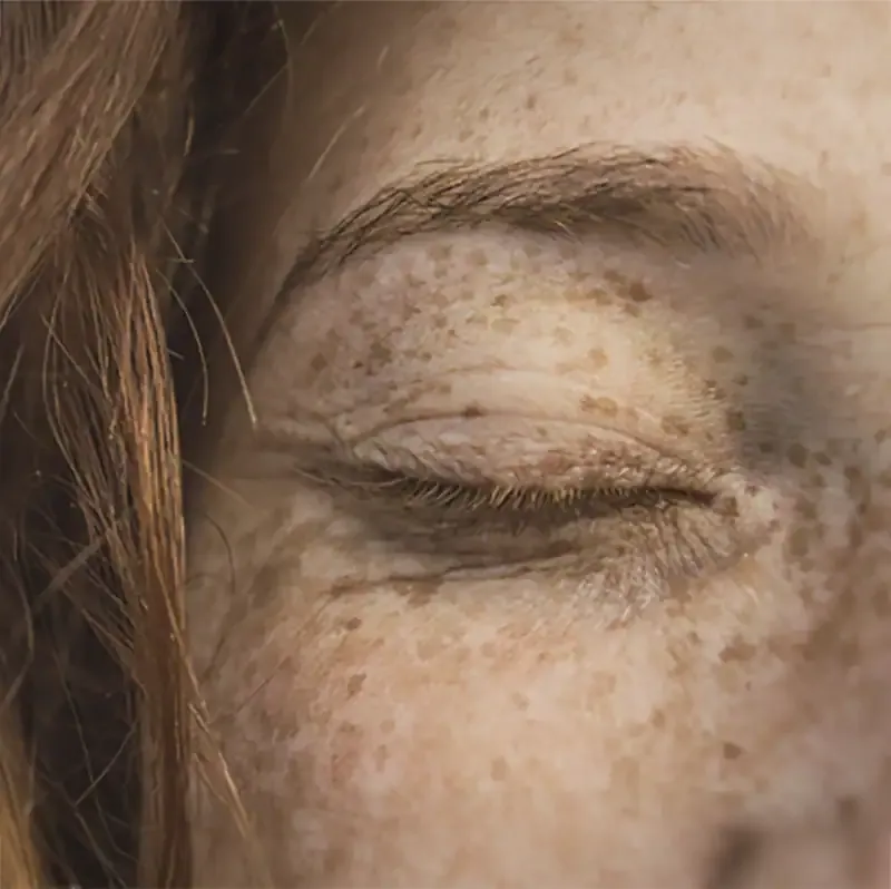 rostro con manchas alrededor del ojo